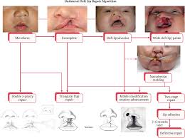 A child usually has one or both of these conditions at birth. 4 Cleft Lip Repair Unilateral Plastic Surgery Key