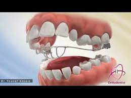 دكتور يوسف قصيص جهاز كبح اللسان تقويم الأسنان youtube lokai bracelet live lokai bracelet jewelry