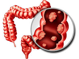 Image result for Colorectal Cancer