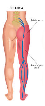 Sitting down does not necessarily cause sciatica. Sciatica Toronto Sciatic Nerve Pain Transform Chiropractic