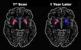 Parkinson's disease (pd) is a degenerative neurological disease that affects the movement. Researchers Examine How Parkinson S Disease Alters Brain Activity Over Time National Institutes Of Health Nih