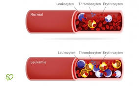 Leukamie Blutkrebs Symptome Ursachen Behandlung Onmeda De