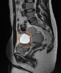 Magnetic resonance imaging (mri) has become a mainstay for diagnosis and staging of this disease. Endometriosis Mri Wikidoc
