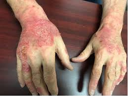 Image result for contact dermatitis