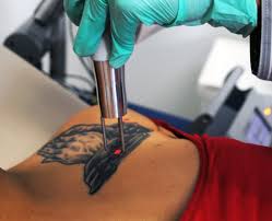 It is estimated that 50 percent of those who get tattoos later regret them. How Laser Tattoo Removal Works Brief Walkthrough Laserall