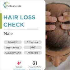 Hair Fall In Men - Dht Male Hair Loss Blood Test In Hyderabad –  Mydiagnostics