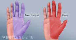 Image result for carpal tunnel