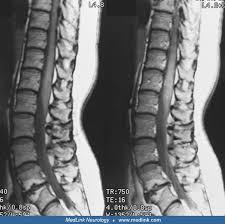Image result for Myelitis