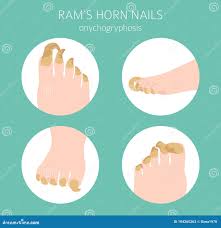 Image result for Onychogryphosis feet