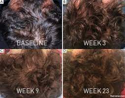 Even hair specialists recommend stem cell therapy for hair regrowth. Stem Cell Therapy For Hair Loss Potential And Limitations Hairverse
