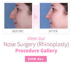 The symptoms are often worse on one side. Nose Surgery Rhinoplasty Ocala Plastic Surgery