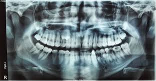 Supernumerary Teeth In A 7-Year Old Male- Diagnosis And Management | Supernumerary  Teeth In A 7-Year Old Male- Diagnosis And Management - Kazemi Oral Surgery  | Facialart.Com