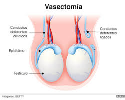 La vasectomía es una intervención quirúrgica sencilla que se lleva a cabo con fines anticonceptivos en los hombres. Que Es Una Vasectomia Y Otras 6 Preguntas Clave Sobre Este Procedimiento De Esterilizacion Masculina Bbc News Mundo