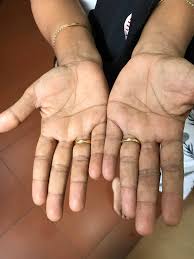 This may be due to vascular changes related to the increase in estrogen levels during pregnancy. Cureus Palmar Erythema As The Sole Manifestation Of Covid 19