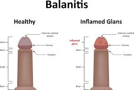 Image result for balanoposthitis