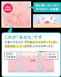 ユースキン あせも ブランドサイト｜ユースキン製薬株式会社