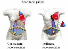 Located on or affecting the same side of the body. Preferred Use Of The Ipsilateral Pedicled Tram Flap For Immediate Breast Reconstruction An Illustrated Approach Springerlink