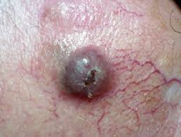 How to check your skin Abcdefg Of Melanoma Dermnet Nz