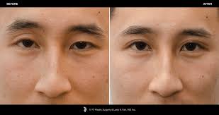 Check spelling or type a new query. Asian Eyelid Surgery 77p Gallery 77p Gallery