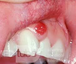 Image result for granuloma gum disease