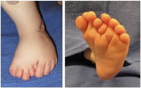 Image result for Supernumerary Digit