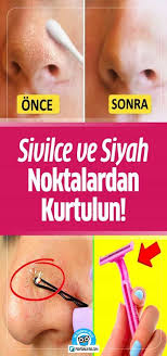 Sivilce Ve Siyah Noktalardan Kurtulun Faydali Bilgin Siyah Noktalar Sivilce Izi Cilt Bakimi