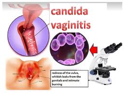 Image result for Vaginitis