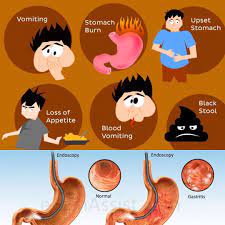 Mike Metzger On Instagram So Here S What S Up With Me Apparently Crohns Can Go And Attack Your Stomach As Well And Cause Acute Crohns Disease Crohns Nsaids