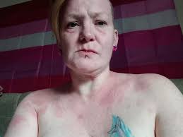 So my skin across my shoulders, up my neck, down my arms and