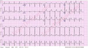 Image result for Early Repolarization