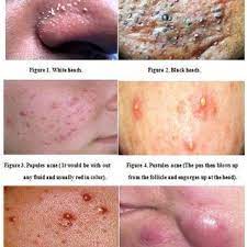 Acne nodules can be large, ugly, painful and embarrassing. Pdf Acne Causes And Amazing Remedial Measures For Acne