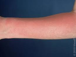 Image result for Sunburn