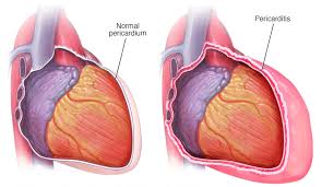 بیماری پریکاردیت یا التهاب آب شامه قلب ؛ علائم، علل و درمان | کافه پزشکی