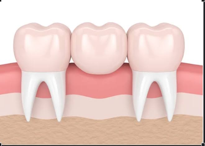 Dental Bridges product image