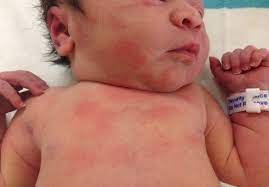6 Common Newborn Rashes Utah Valley Pediatrics