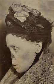 Primary syphilis secondary syphilis latent syphilis tertiary (third, or late) syphilis other symptoms. Syphilis Shocking Photos Of Victims Before Penicillin Lj Charleston