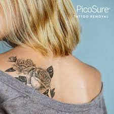 Getting my tattoo lasered off with picosure laser tattoo removal before and after first session. Laser Tattoo Removal Southeastern Dermatology In Knoxville Tn