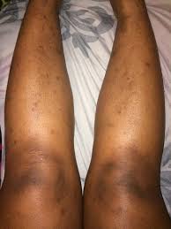 Replace with a bath using a baking soda mixture. Old Scars From Bug Bites How To Get Rid Of Them Or Lighten Them I M Tired Of Wearing Pants Photo