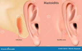 Image result for Mastoiditis