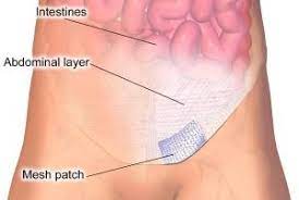 Surgery Inguinal Hernia Hernia Repair Hernia Surgery