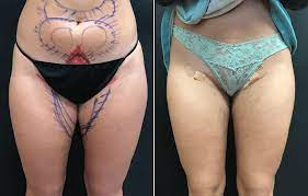 Laser Lipo For Inner Thighs Before And After Photos New Jersey