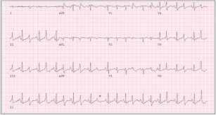 Image result for Extrasystole