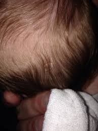 Image result for dry scabs on the head in children