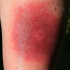 Zeckenbiss Rotung Darum Sollten Sie Bei Einer Wanderrote Schnell Zum Arzt Gesundheit