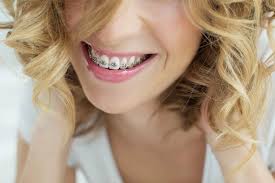 Zahnspange kann ziemlich standard sein, aber es gibt tatsächlich viele unglaubliche fakten über sie, die zahnspangen sind weit mehr als nur eine kosmetische investition. Zahnspange Fur Erwachsene Kosten Arten Dauer