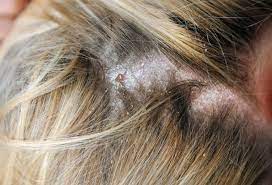 kopfhautentzundung symptome ursachen und therapie heilpraxis