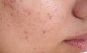 Of course, your specialist is the main person whose advice you should follow but it doesn't do anyone harm. Skin Cancer Symptoms Treatments Causes Tests Preventions
