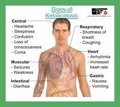 What Is A Diabetic Ketoacidosis Life Saving Info You Need To Read Whatisdiabetes Type1diabetes What Causes Diabetes Diabetic Ketoacidosis Diabetes