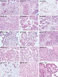 Check spelling or type a new query. Fig S2 Pathology Of Peritoneal Mesothelioma Microphotographs Of Download Scientific Diagram