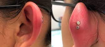 Piercing Infection The Complete Symptoms And Treatment Guide 2020